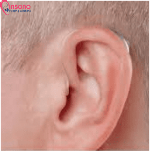 ReSound Key 462 RIE view 2